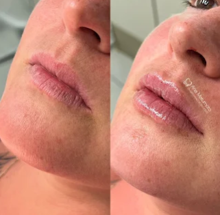 Antes e depois — preenchimento labial
